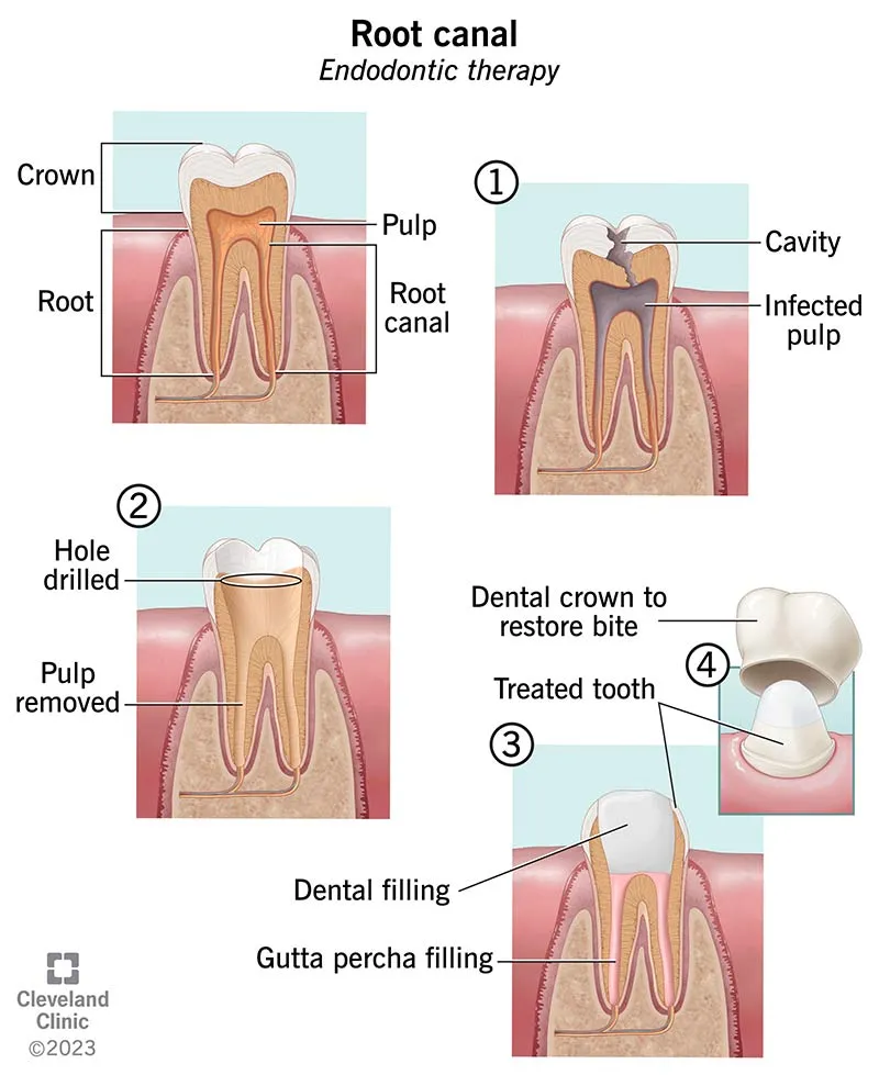 Root Canal Treatment view 3