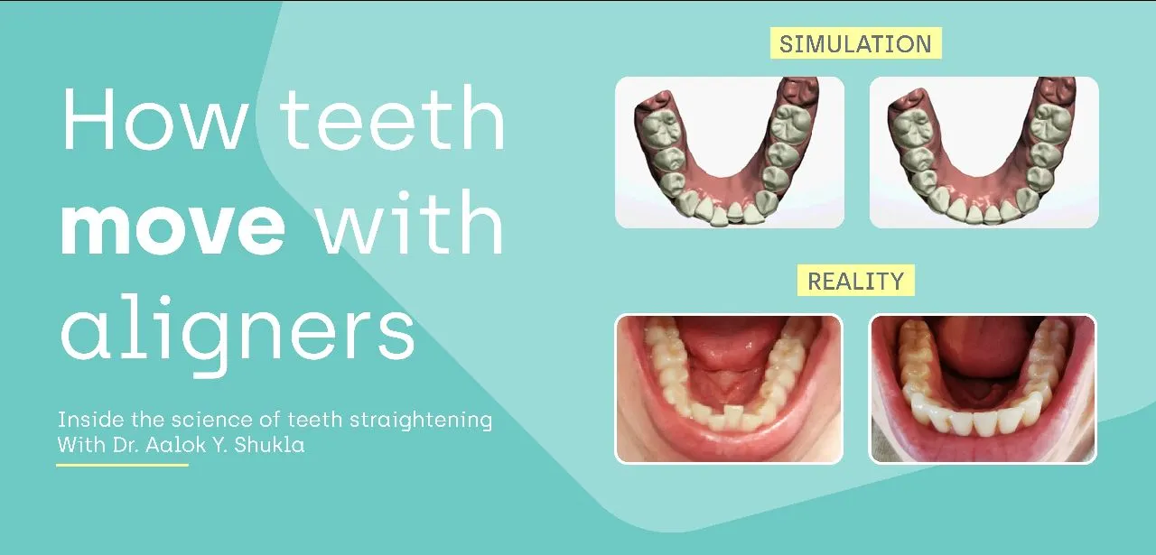 Aligners And Braces Treatment view 2