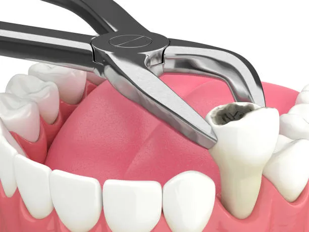 Painless Tooth Removal view 2