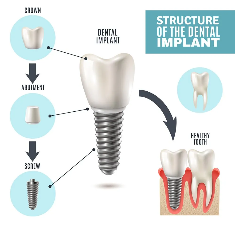 Implant Surgery view 2