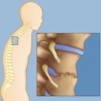 Spondylitis view 3