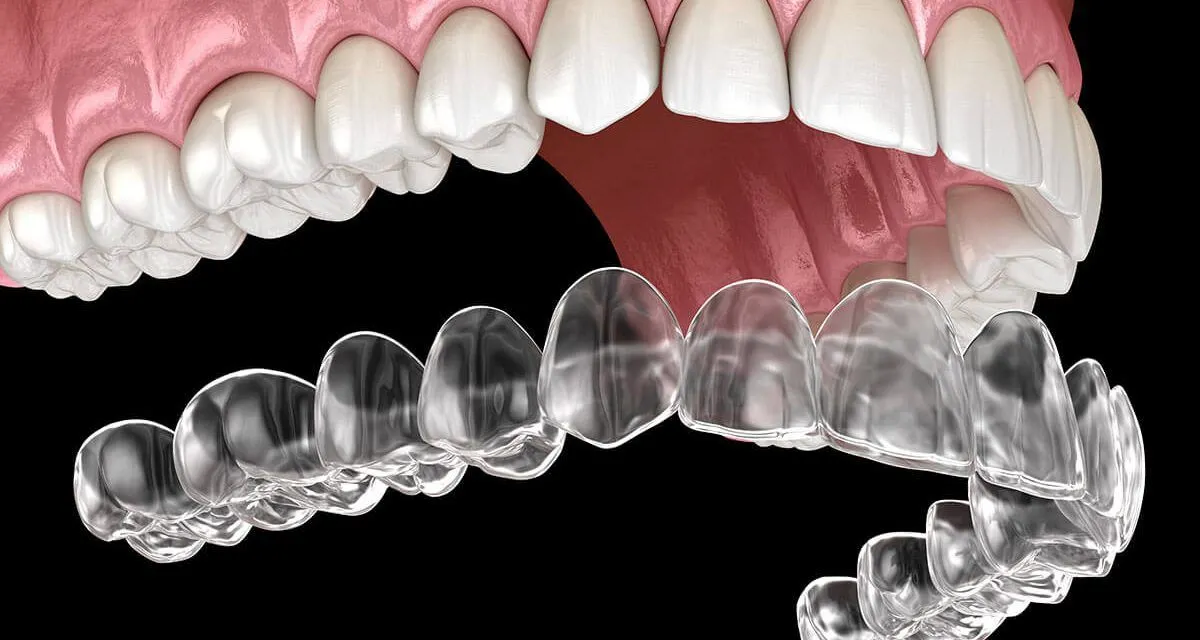 Aligners And Braces Treatment view 3