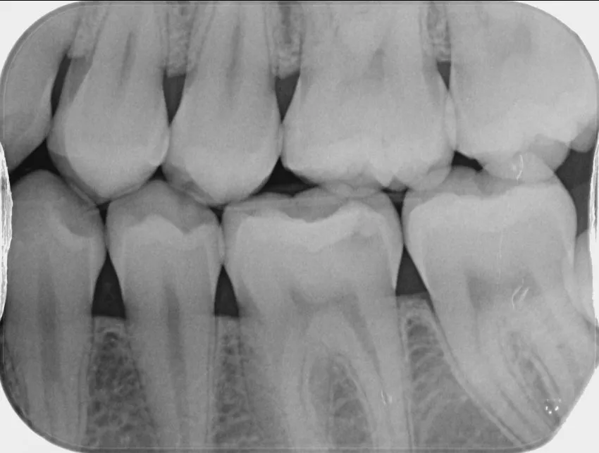 Digital Dental X-Ray view 2