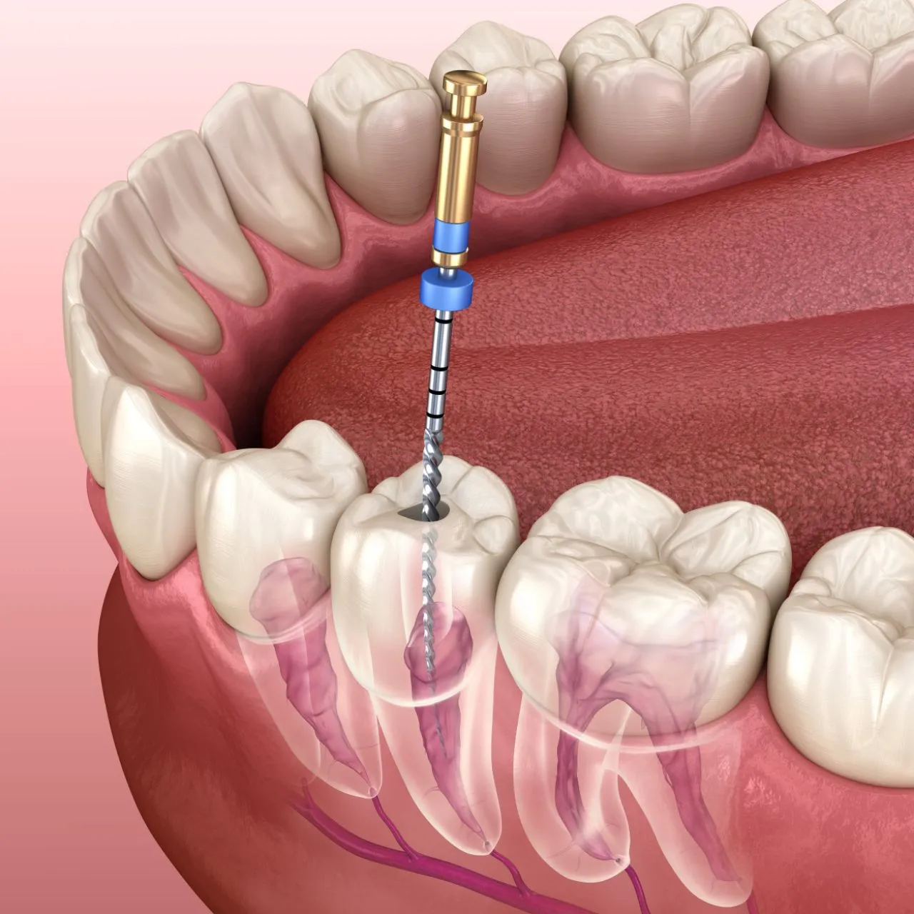 Root Canal Treatment view 2