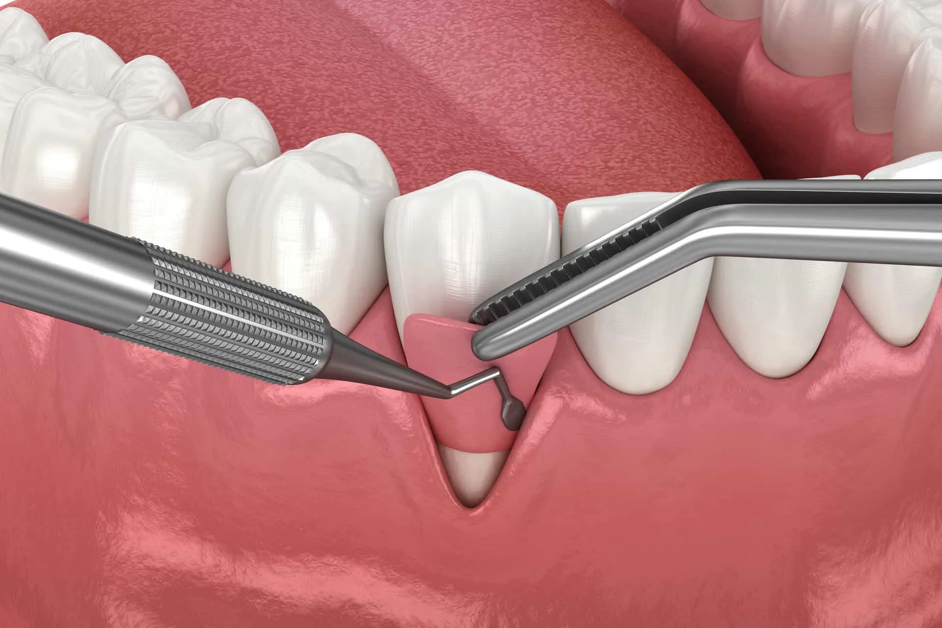 Gum Surgery view 4