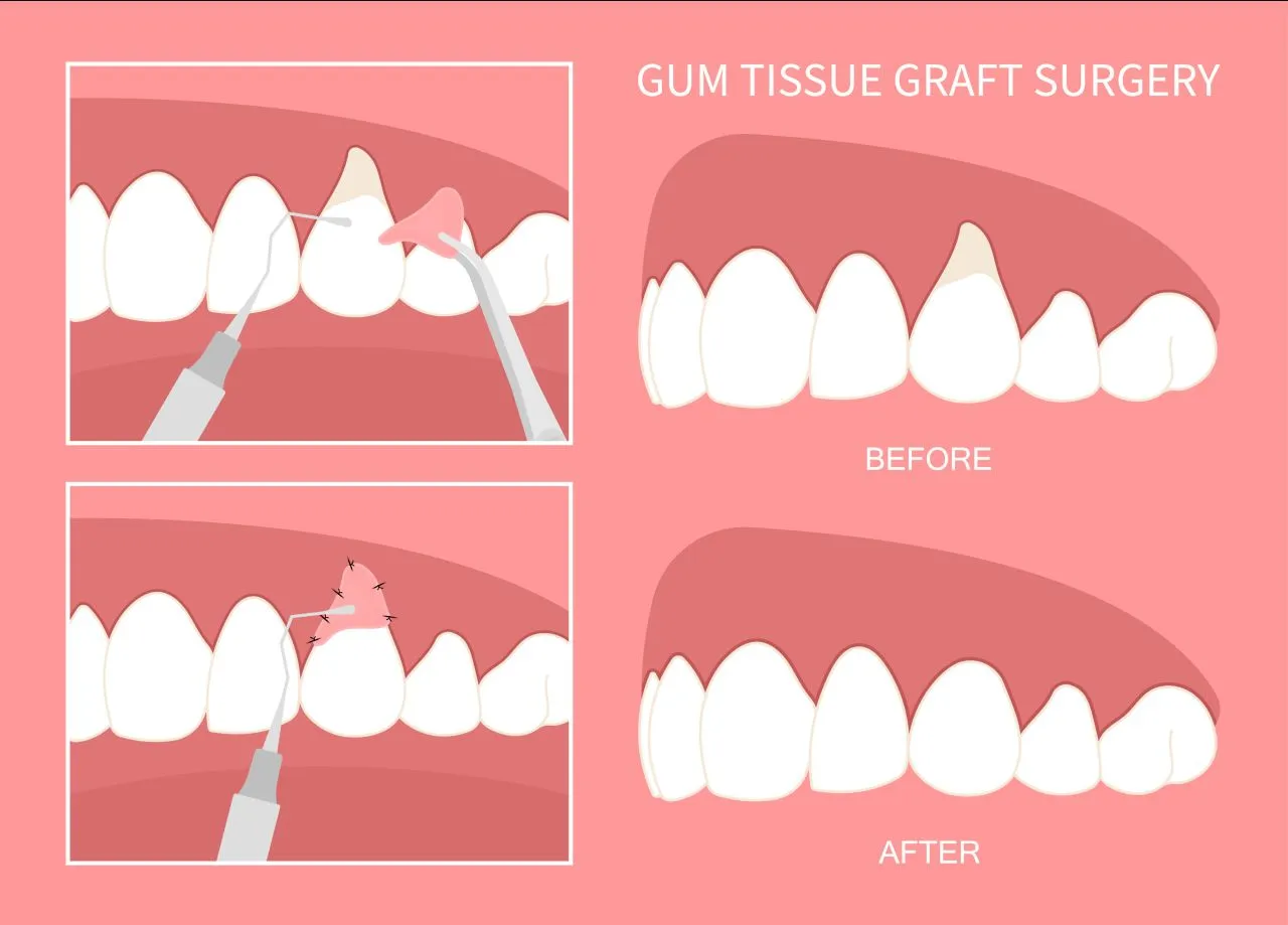 Gum Surgery view 5
