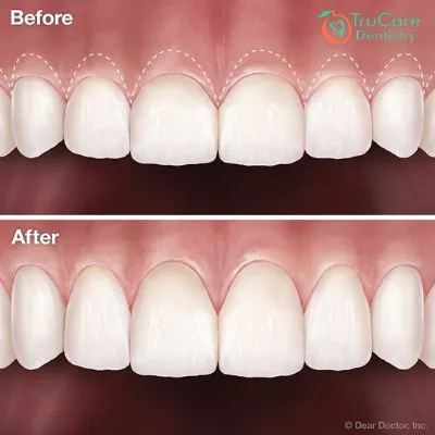 Gum Surgery view 3