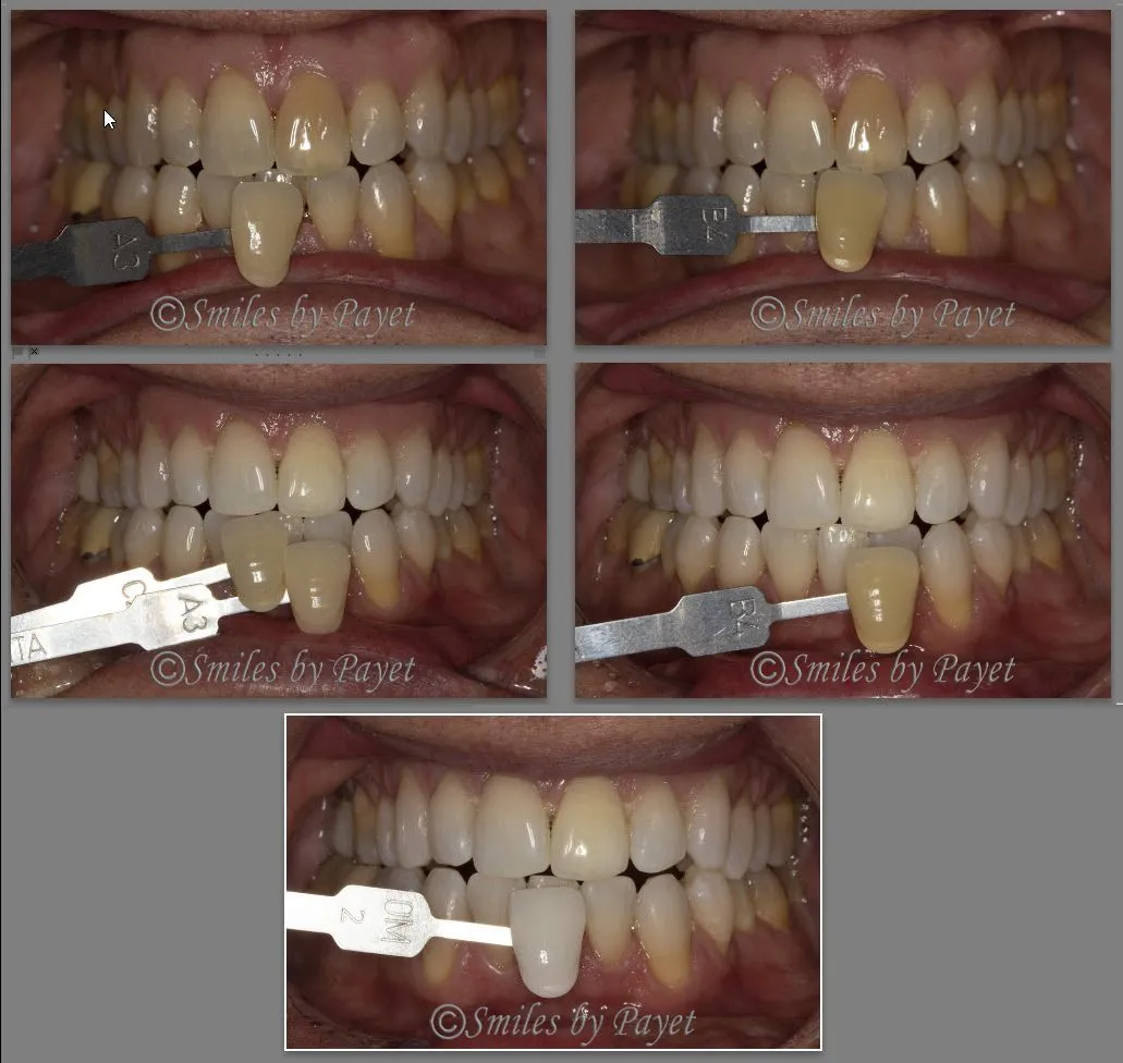 Bleaching/Teeth Whitening view 3