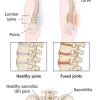 Spondylitis view 2