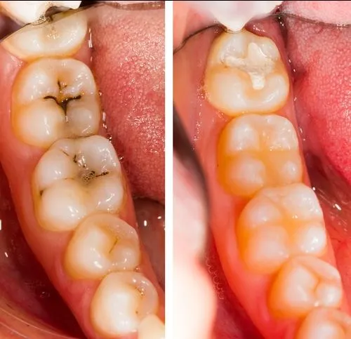 Dental Tooth Filling view 3