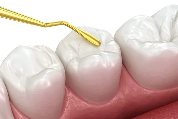 Dental Tooth Filling view 2