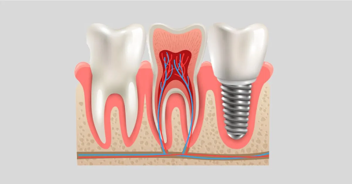 Painless Root Canal Treatment view 2