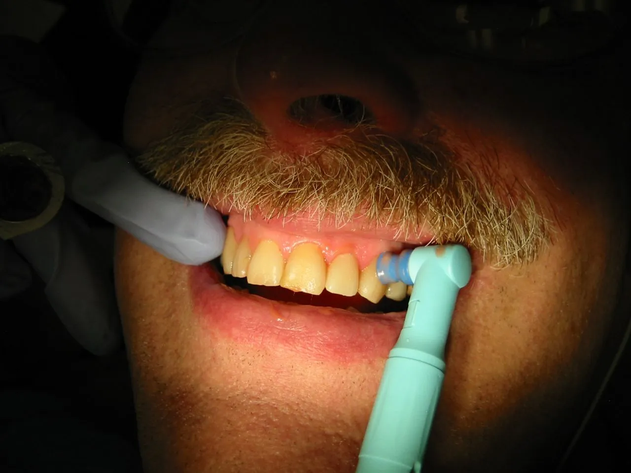 Teeth Cleaning And Polishing view 5