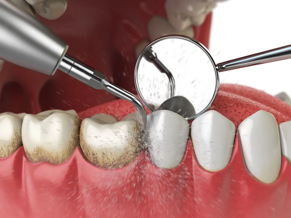 Dental Cleaning view 2