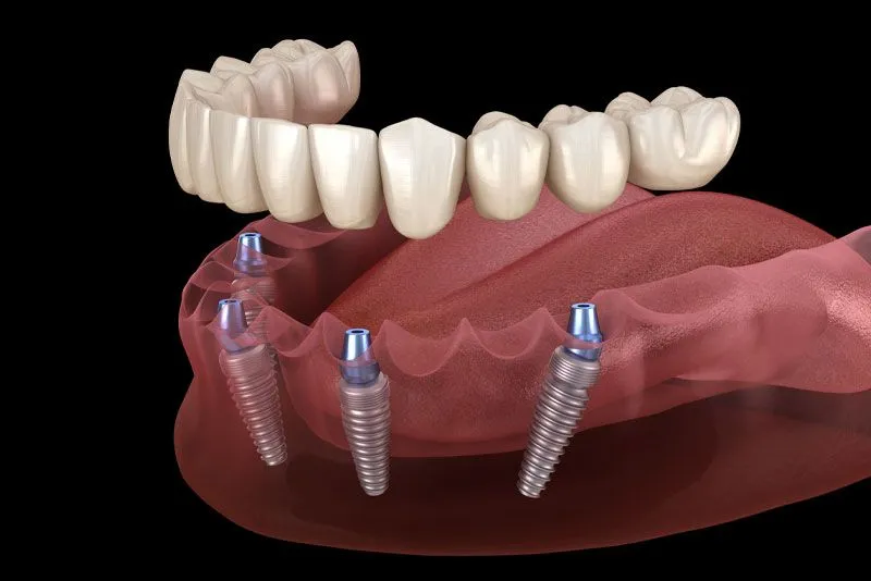 Implant Surgery view 3