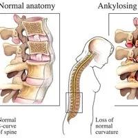 Spondylitis view 5