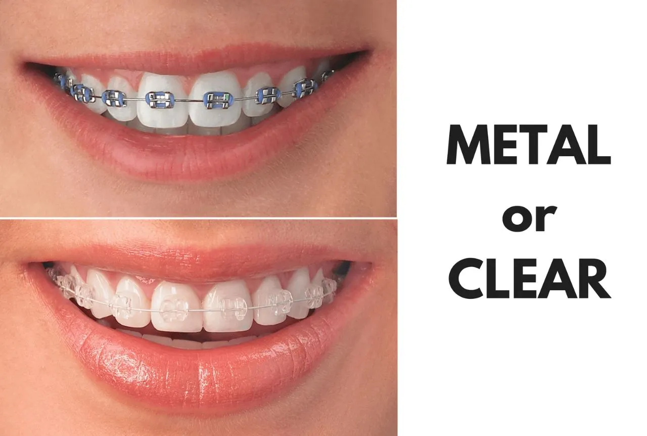 Aligners And Braces Treatment view 5
