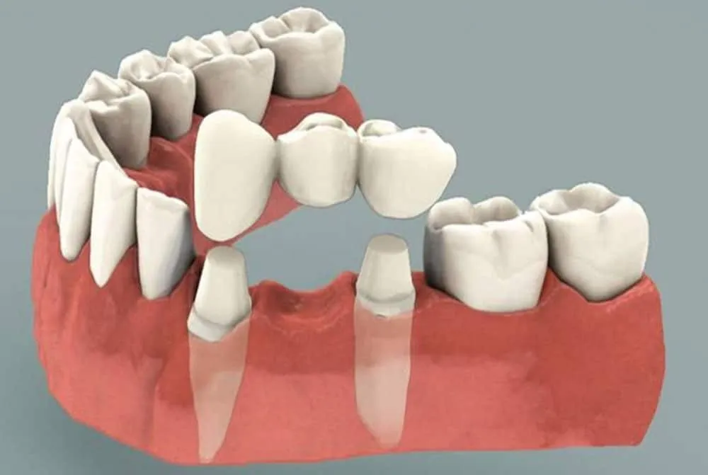 Fixed And Removable Dentures view 3