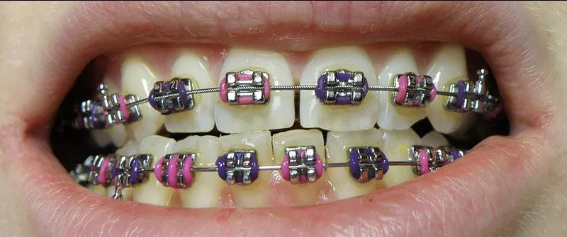 Aligners And Braces Treatment view 4