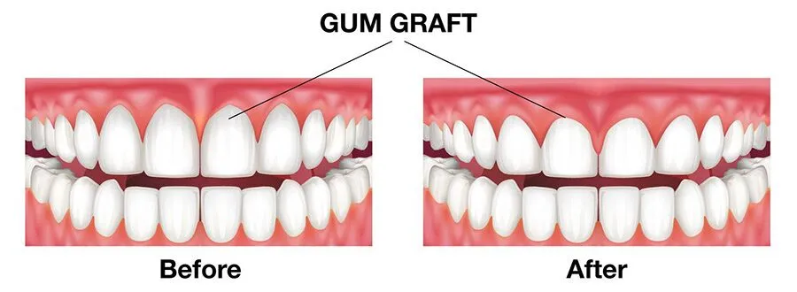Gum Surgery view 2
