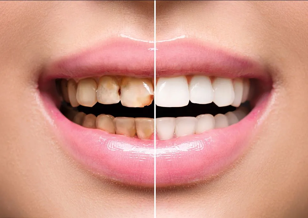 Bleaching/Teeth Whitening view 5