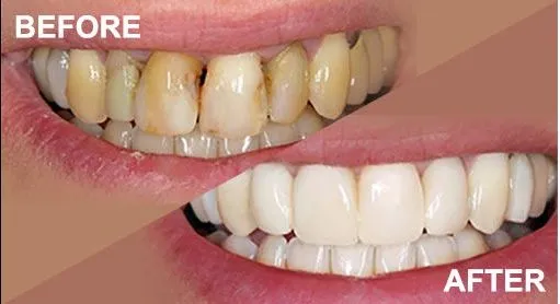 Teeth Cleaning And Polishing view 2
