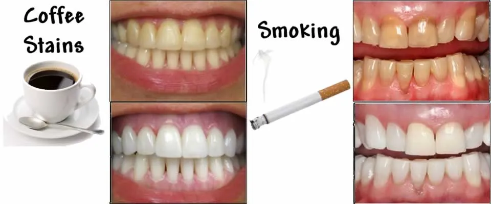 Bleaching/Teeth Whitening view 4