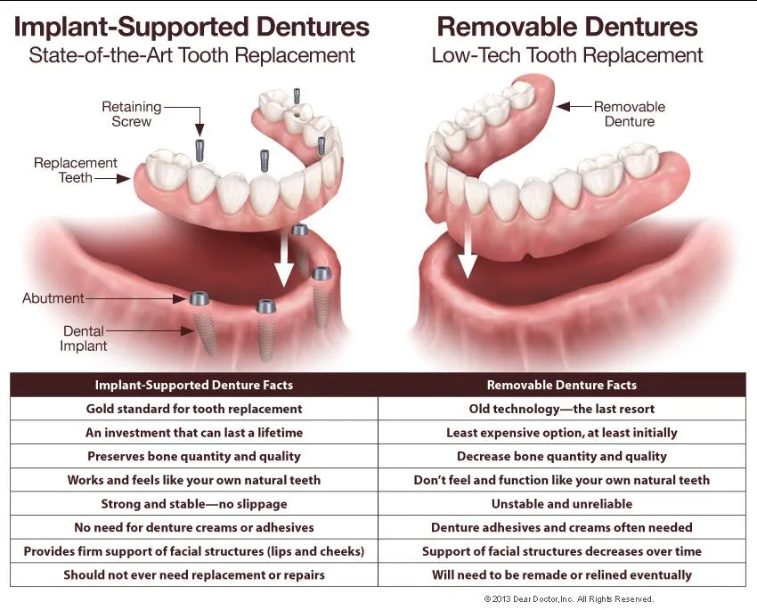 Fixed And Removable Dentures view 4