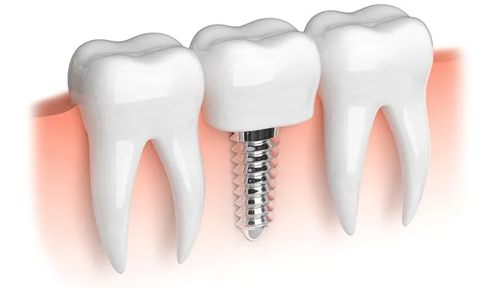 Dental Implant view 2